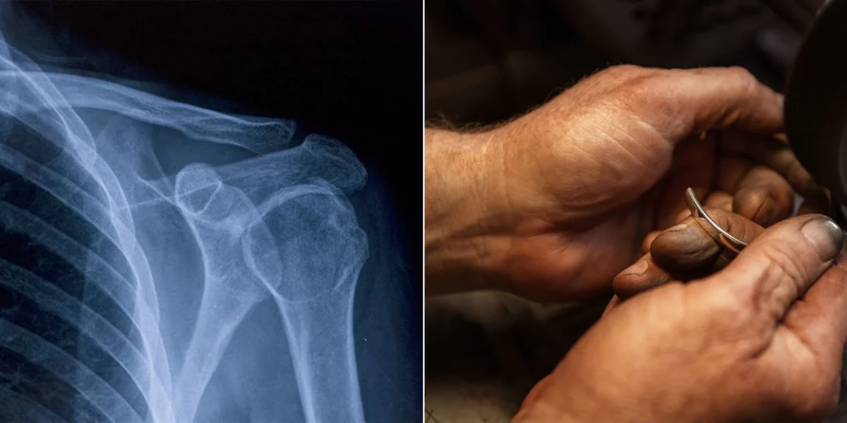 Left image: X-ray. Right image: silver bangle in hands